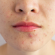 Illustration for article titled Scientists Still Don't Really Know What Causes Acne
